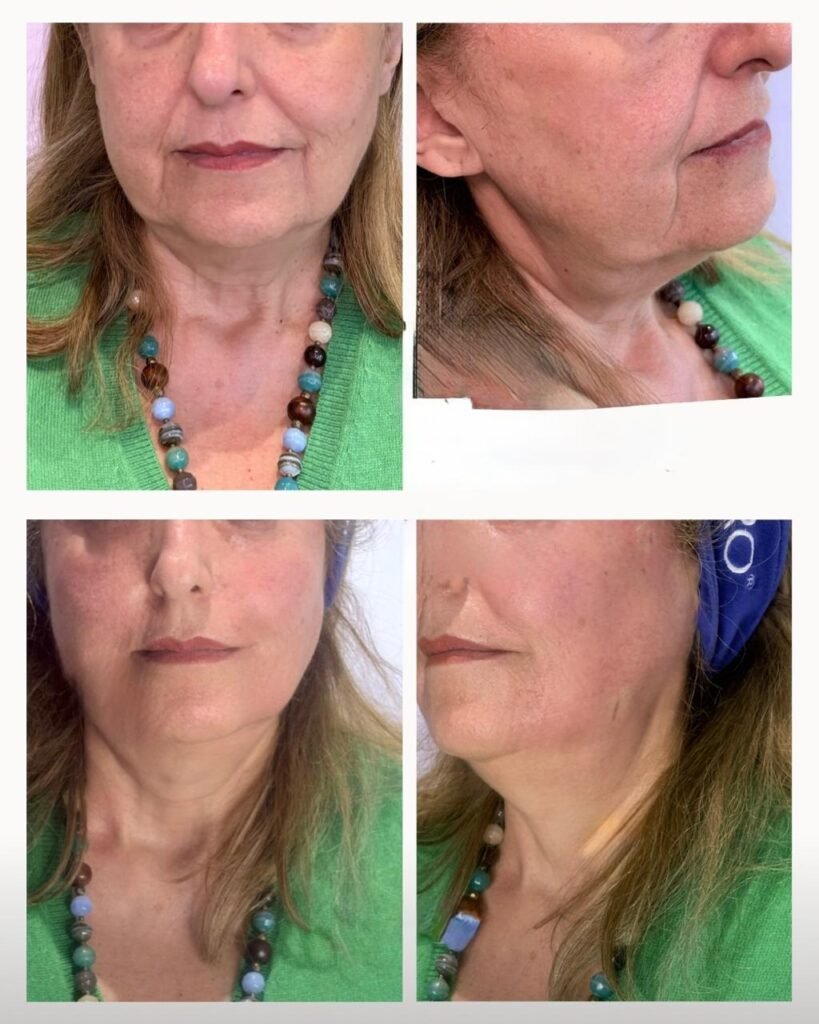 filler γνάθου Αθήνα πριν μετά