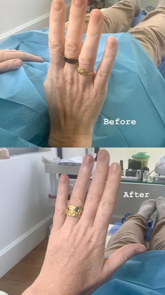 ραντιές πριν και μετά Αθήνα