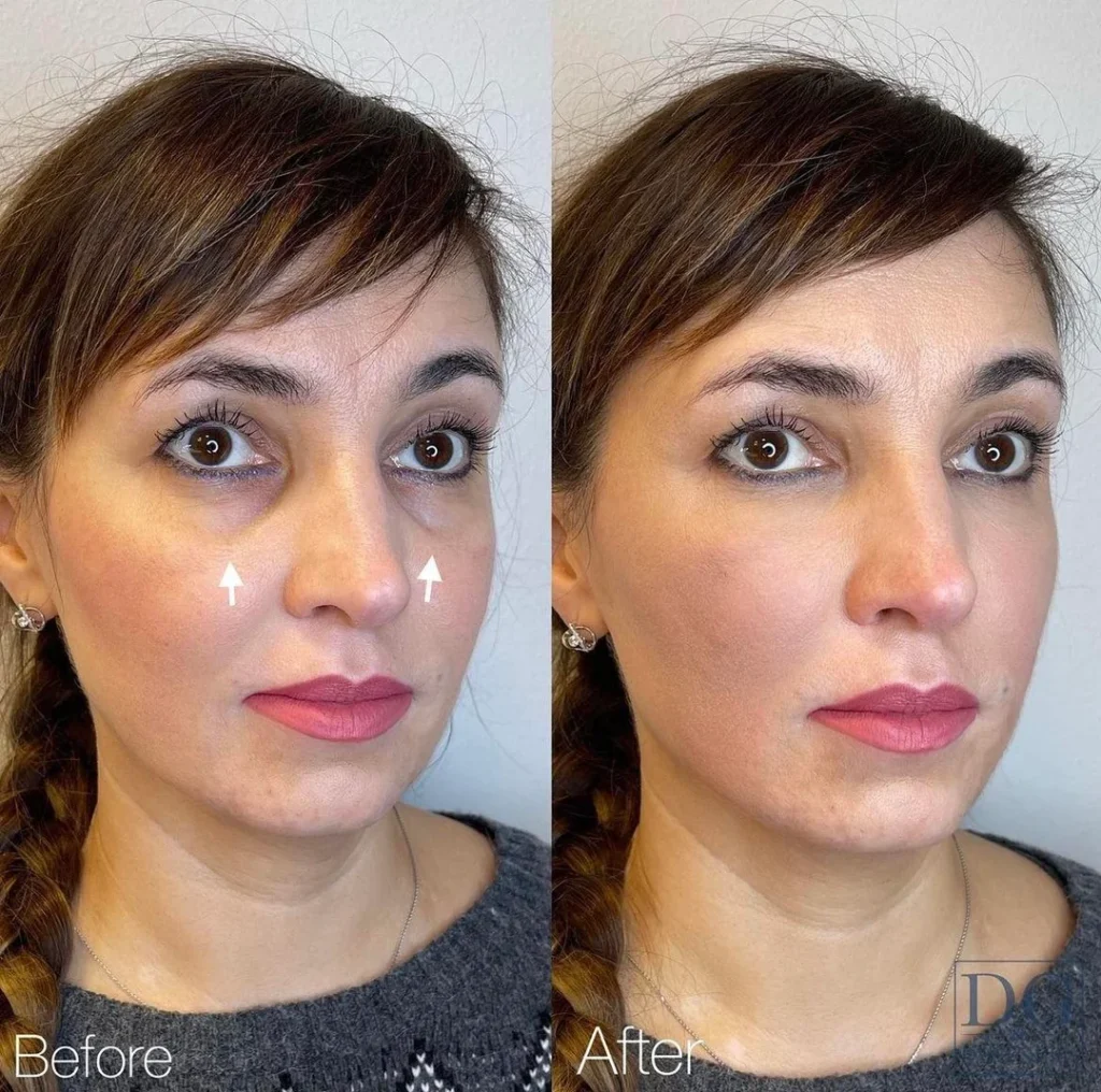 Ραντιές Παρενέργειες | Είναι Ασφαλές το RADIESSE;