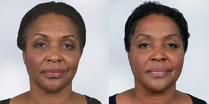 πολυγαλακτικό οξύ πριν και μετά