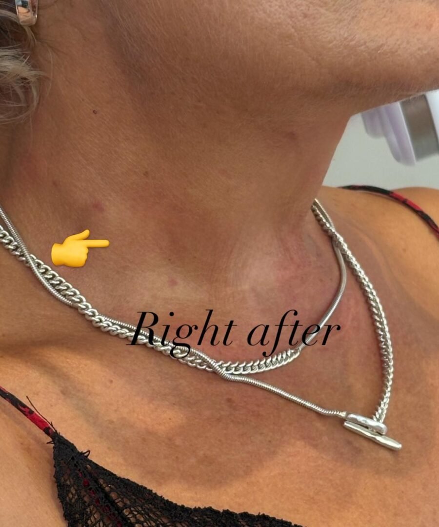 After bio filler