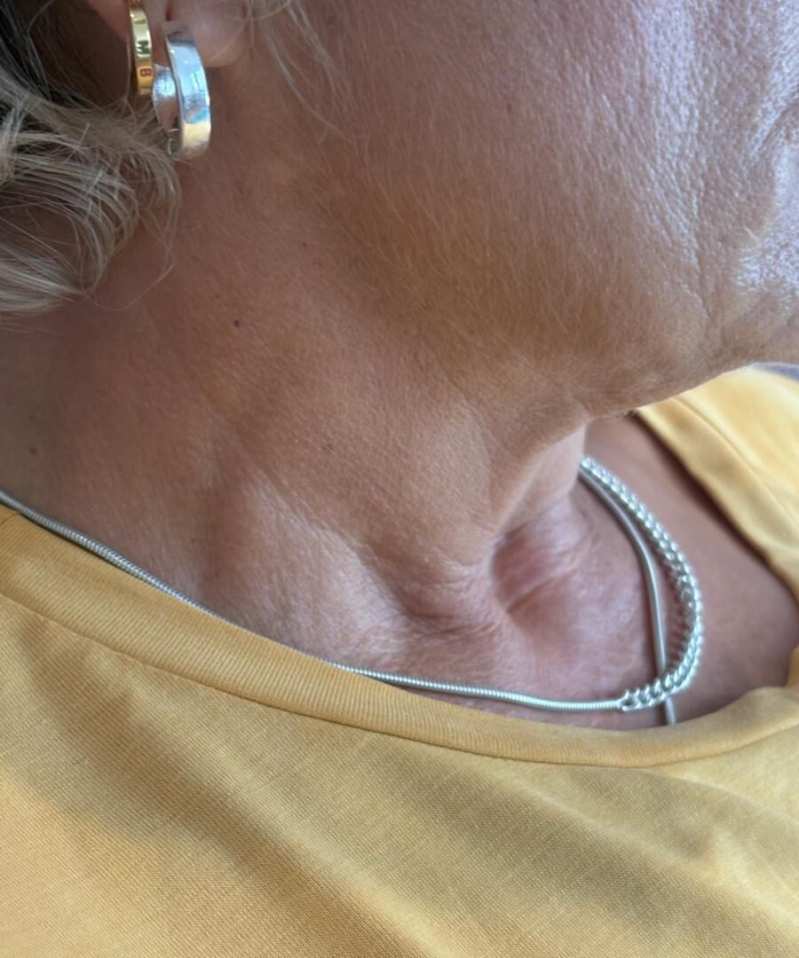 Before bio filler