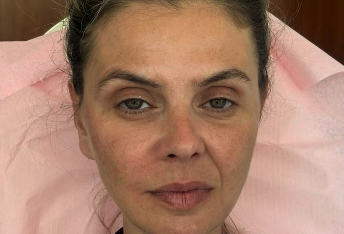 θεραπεία RRS® HA Long Lasting by SKIN TECH